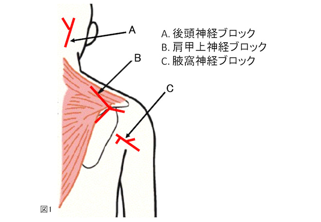 神経ブロック注射